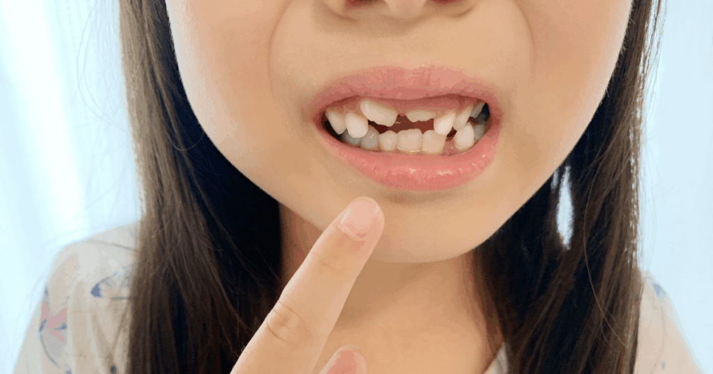 前歯のかみ合わせを指さしている子どもの口元の写真。口の機能と歯並びの関係を説明する記事内画像。