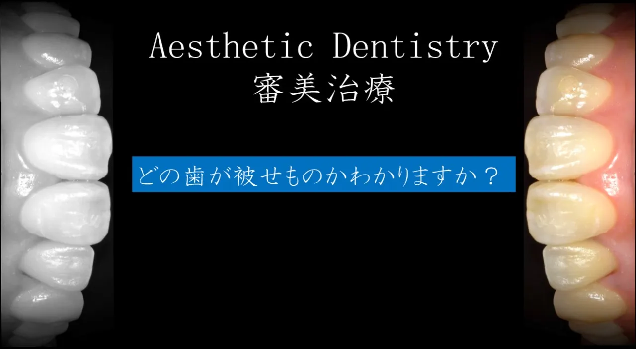 審美歯科治療の事例紹介