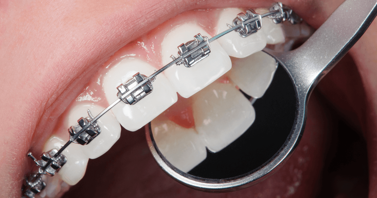 発達障害　歯科矯正　困りごと